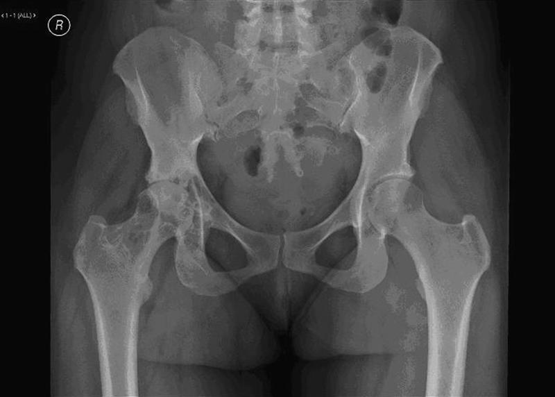 The knee is the most commonly involved joint, but others include the hip, ankle, shoulder, and elbow. PVNS often appears in the third and fourth decades of life. No sex-based predilection.