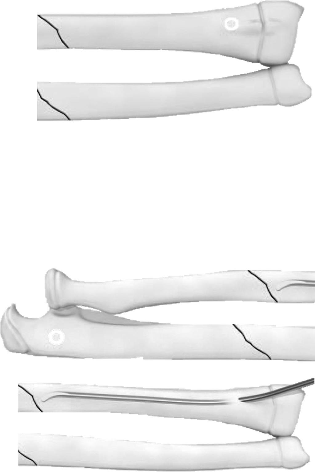 SURGICAL TECHNIQUE FOR PEDİATRİC FOREARM FRACTURES Forearm fractures in children typically require a single nail inserted in each bone.