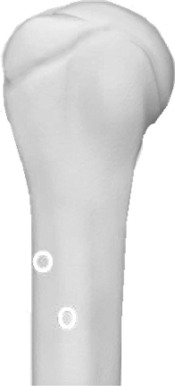 Radial neck : Use 1.5-2.5 mm Nancy nail. Use same entry as for distal radius, advance retrograde to radial neck.