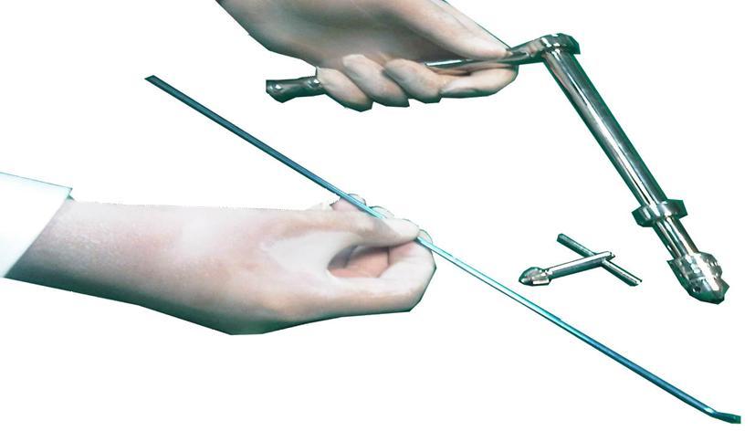 The nail adapts to the anatomic requirements and allows minimally invasive surgery.