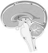 CEREBROSPINAL FLUID FLOW LATERAL VENTRICLES SUBARACHNOID SPACE THIRD VENTRICLE BLOODSTREAM FOURTH VENTRICLE Hydrocephalus is often present at the time of diagnosis if the tumor has blocked the