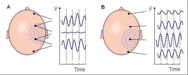 Measuring EEG: bipolar or referential? Fig. 13.