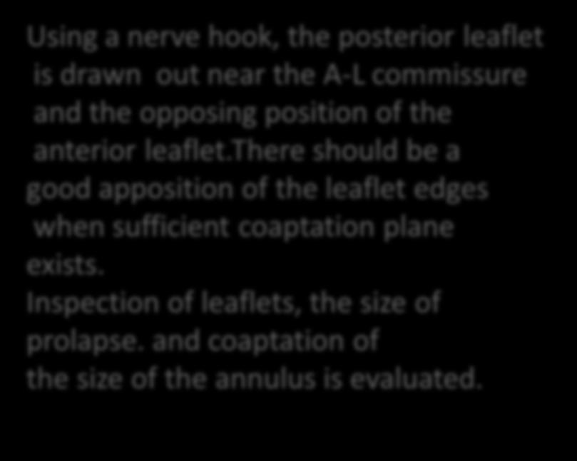 Using a nerve hook, the posterior leaflet is drawn out near the A-L commissure and the opposing position of