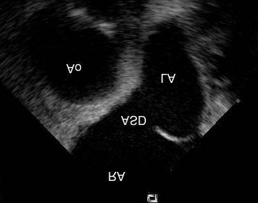Sang-Chol Lee, et al:intracardiac Echocardiography for ASD Closure 613 Fig. 1. View of the ASD as visualized by intracardiac echocardiography.