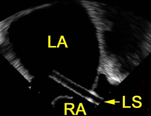2 and 3), including imaging of the interatrial communication during balloon sizing, device unfolding and release, and during the final check for adequate positioning.
