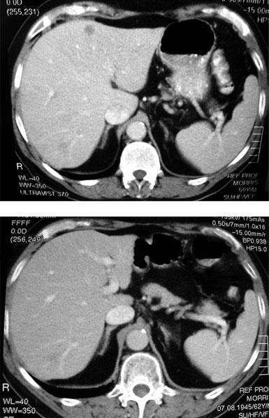 CT imaging before and 27 months after SIRT in a patient who had a CR