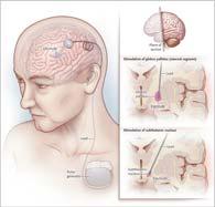 Deep Brain Stimulation in the Treatment of Movement Disorders Disclosures None