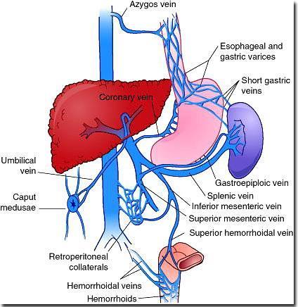 CLINICAL MANIFESTATIONS Hematemesis from bleeding esophageal or gastric varices may