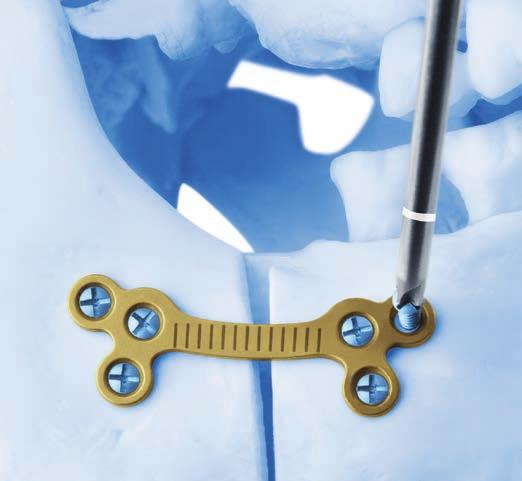 Sagittal Split Fixation 4 Fixate plate to the bone Select the appropriate 1.4 mm diameter drill bit length to allow for the adequate clearance of nerves, tooth buds, and/or tooth roots.