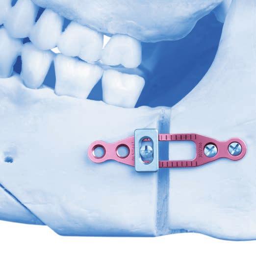 Sagittal Split Plate with Adjustable Slider (optional) 4 Primary plate fixation Select the appropriate 1.