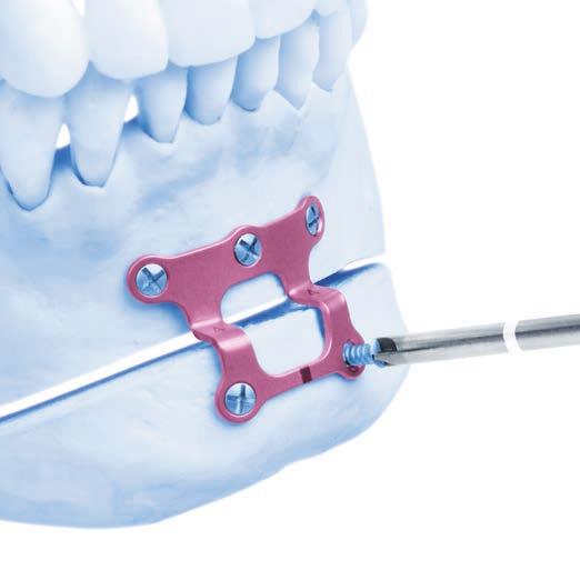 Genioplasty Fixation 3 Fix plate to bone Use a 1.4 mm drill bit to drill, and insert the proper length 1.85 mm diameter MatrixORTHOGNATHIC Screws to fixate the plate to the bone.