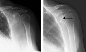 Failed Previous Shoulder Replacement Surgery Although uncommon, some shoulder replacements fail, most often because of implant loosening, wear, infection, and dislocation.