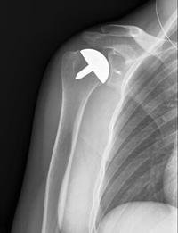 This x-ray shows the cap-like prosthesis used in resurfacing hemiarthroplasty.