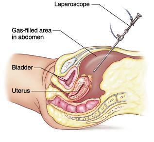 Laparoscopy-Hysteroscopy Patient Information Laparoscopy The laparoscope, a surgical instrument similar to a telescope, is inserted through a small incision (cut) in the belly button during