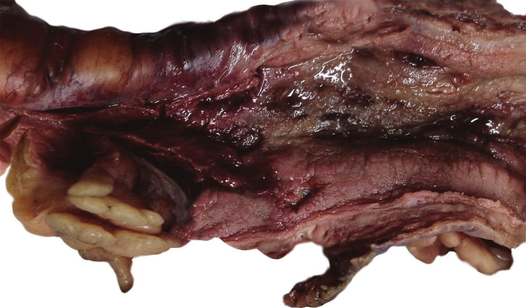 2 Figure 1: Macroscopic appearance of colectomy material.