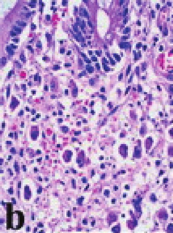 Immunohistochemical analysis revealed the CMV positivity in inclusion containing cells (Figures 2(d) and 2(e)).