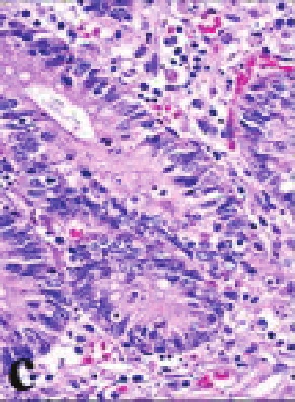 CMV inclusion containing cells were detected in postmortem biopsies taken from liver, lungs, and lymph nodes (Figures 3 