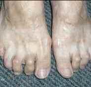 Illustrated quizzes on problems seen in everyday practice Hammer Toe Case 1 This 48-year-old gentleman has a long history of Rheumatoid arthritis, for which he has been on Methotrexate 10 mg weekly