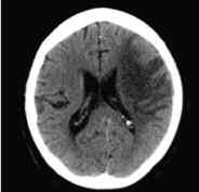 Case 2 Hypodensity A 77-year-old right handed female presented with sudden onset of speech impairment, word finding problems and right sided weakness. 1. What does this image show? 2. What is your diagnosis?