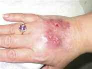 Case 5 Non-Healing Ulcer A 48-year-old female, who is otherwise healthy, has a nine month history of a painful non-healing ulcer on the dorsum of her right hand.