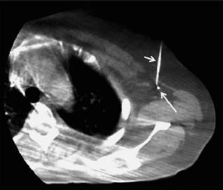 Materials and Methods Wire localization of marker-clipped nodes Cone-beam CT (CBCT) was performed for the selected