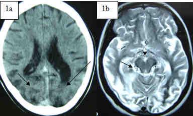 Romanian Neurosurgery (2016) XXX 1: 132-135 133 suggestive of Moyamoya disease. The detailed laboratory workup did not reveal any cause of progressive arteriopathy.