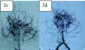 Brain MRI shows flow voids around midbrain (1b) Figure 2 - Cerebral digital substraction angiography revealed occlusion of both supraclinoid internal carotid artery (2a & 2b) with collateral