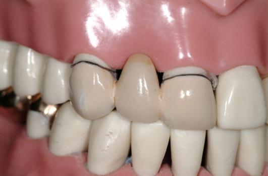 Porcelain Primer and Hydrofluoric Acid used for porcelain crowns. 2) Gold Crown Preparation 1.