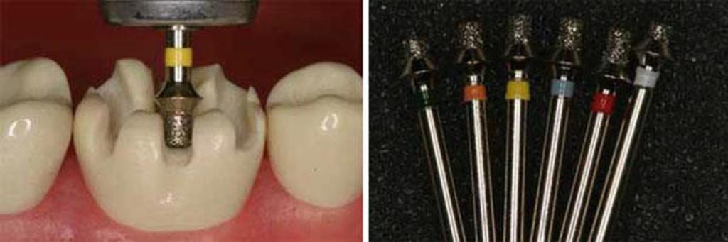 max when using traditional cementation.