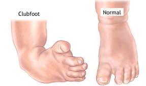 CLUBFOOT TALIPES EQUINOVARUS FOOT TURNED IN AND DOWN POSITIONAL VS.