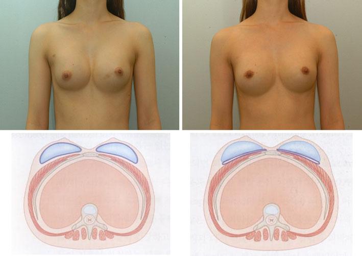 4 Left A 33-year-old woman with symmastia after original breast augmentation. Right Postoperative 9-month view the capsule.