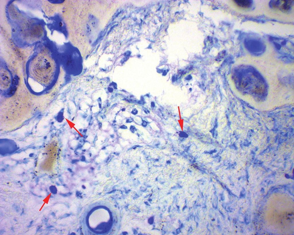 a B C D Figure 1: Mast cells (arrows) in oral reactive lesions: A) Mast cells with granules in peripheral region of a peripheral giant cell