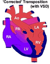 Congenitally Corrected Transposition of the Great Arteries In this complex malformation the ventricles are on the opposite side of the heart to the usual.