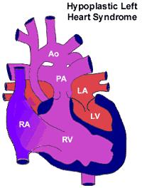 Hypoplastic Left Heart Syndrome HD The left side of the heart is very poorly formed and cannot support the main circulation (round the body).