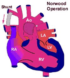 Norwood Operation The Norwood operation involves connecting the origin of the pulmonary artery to the aorta, to allow the right ventricle to pump blood to the main circulation and a 'Shunt'