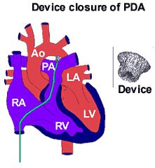 With some larger PDAs a 'Device' (similar to that used for closure of ASD) may be employed. Device closure of PDA Various devices have been used in recent years.