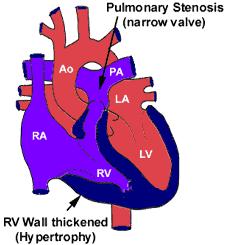Pulmonary Stenosis The Pulmonary Valve is thickened and narrowed leading to the development of abnormally high pressure in the right ventricle.