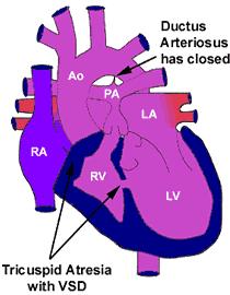 Tricuspid Atresia Absence of any connection between the right atrium and the right ventricle leads to blood being diverted from the right atrium to the left atrium.