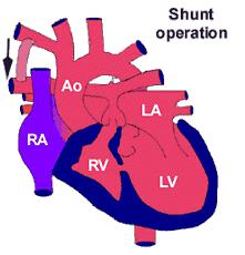 Bidirectional Cavo Pulmonary Connection (BCPC) A Cavo-Pulmonary shunt involves connecting the main vein from the upper circulation (the SVC) to the right pulmonary artery (RPA), in order to direct