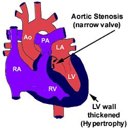 Aortic Stenosis (AS) The Aortic Valve is thickened and narrowed leading to the development of abnormally high pressure in the left ventricle.