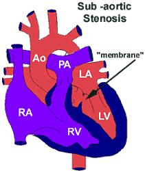 Subaortic Stenosis In this condition the narrowing is below the aortic valve (indicated by arrow). The effect on heart function is similar to aortic valve stenosis.