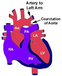 Coarctation of the Aorta HD Fact sheet on Coarctation A narrow area (stricture) is present in the aorta and leads to restricted blood flow to the lower part of the circulation.