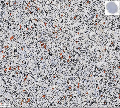 CD8+ T-cell IHC performed by