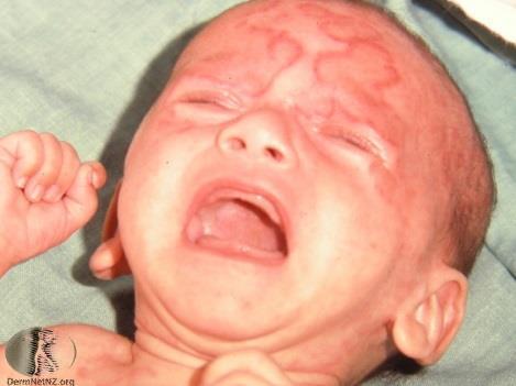Neonatal lupus During pregnancy, antibodies can cross the placenta to the fetus.