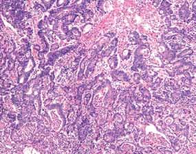 HEREDITARY COLORECTAL CANCER SYNDROMES Invasive colonic adenocarcinoma in Lynch syndrome A B The diagnosis of Lynch syndrome is based on molecular pathology and confirmed by genetic testing C While