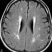 PACNS Primary angiitis of the CNS is a rare disorder with