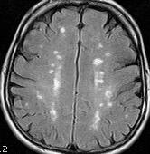 inflammation of small cerebral parenchymal and