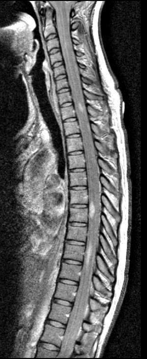 Spinal cord lesions characteristics Small size: < 2 vertebral segments < half of cord cross-sectional area Location: cervical > than the rest lateral + posterior columns central GM not spared