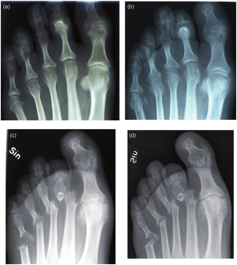 Laasonen et al. 3 Fig. 1. Serial radiographs from 1981 (a), 1988 (b), 2001 (c) through 2010 (d), showing typical changes of psoriatic arthritis mutilans in the left foot of a 58-year-old male patient.
