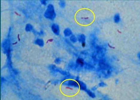 Smear microscopy Mycobacteria do not stain well with Gram stain Carbol fuschin stain: heat